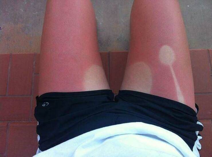 When Sunbathing Goes Wrong…
