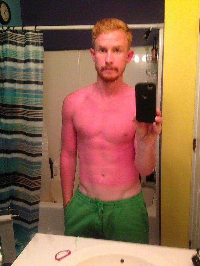 When Sunbathing Goes Wrong…