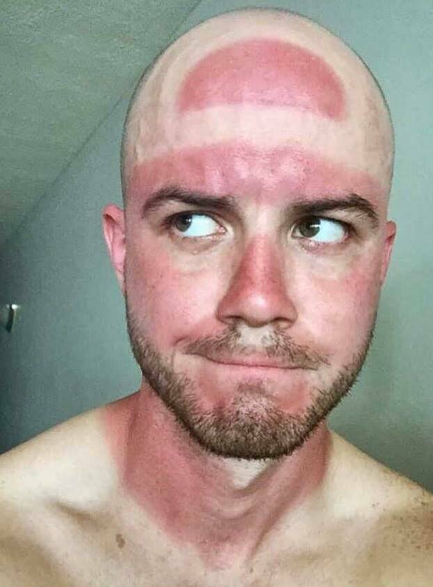 When Sunbathing Goes Wrong…