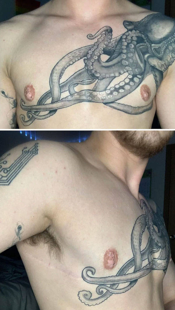 Tattoo Artists Covering Scars And Birthmarks