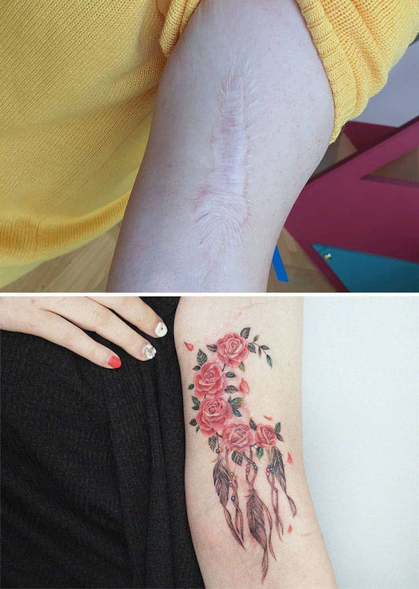 Tattoo Artists Covering Scars And Birthmarks