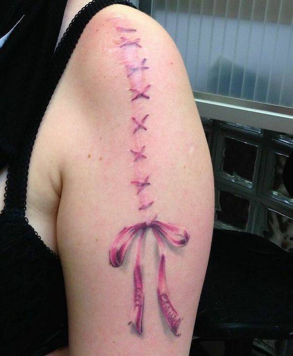 Tattoo Artists Covering Scars And Birthmarks