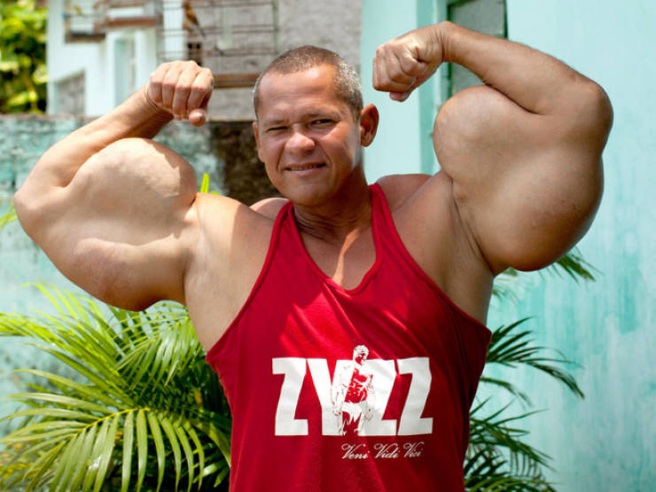 Synthol Does NOT Look Good, Guys…