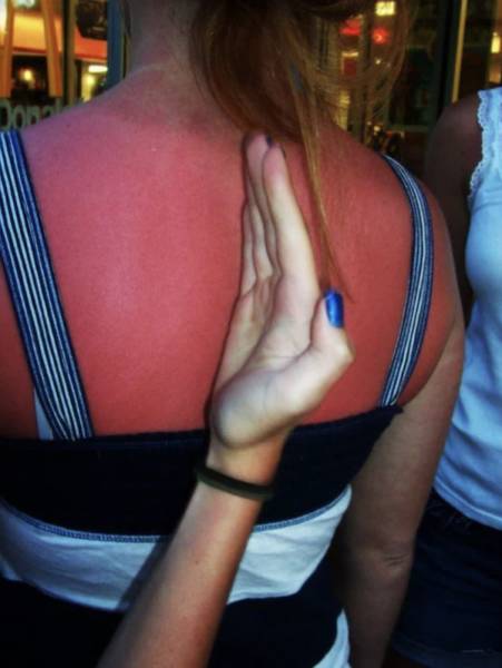 Sunburn Disasters That