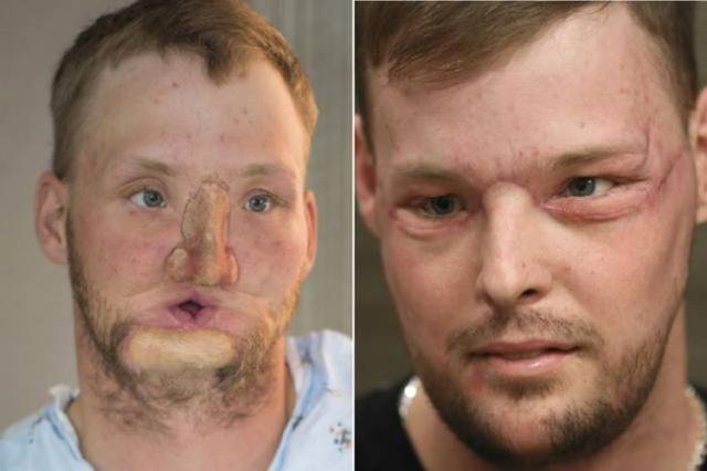 Face Transplantation Is A Thing!