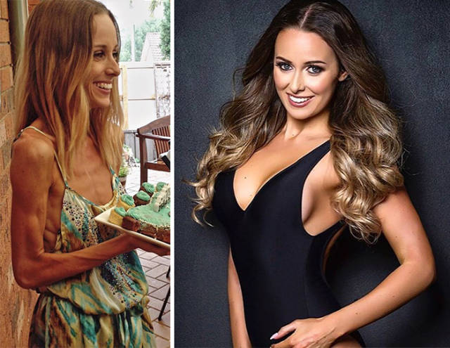 Anorexia Is Not The Final Verdict!