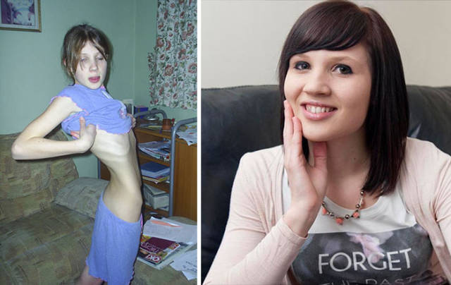 Anorexia Is Not The Final Verdict!