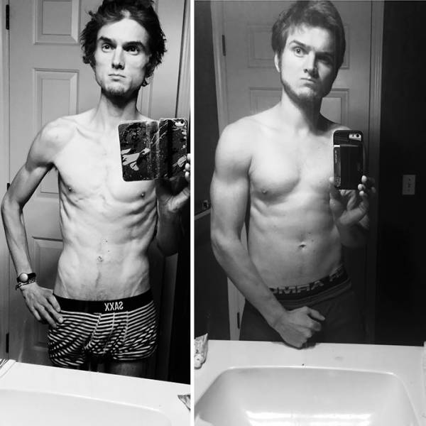 Anorexia Is Not The Final Verdict!