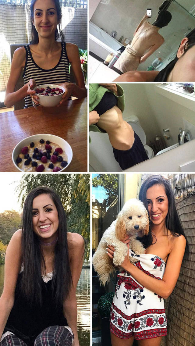 Anorexia Is Not The Final Verdict!