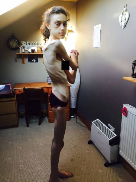 From Anorexia To An Amazing Body!