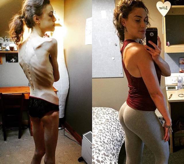 From Anorexia To An Amazing Body!