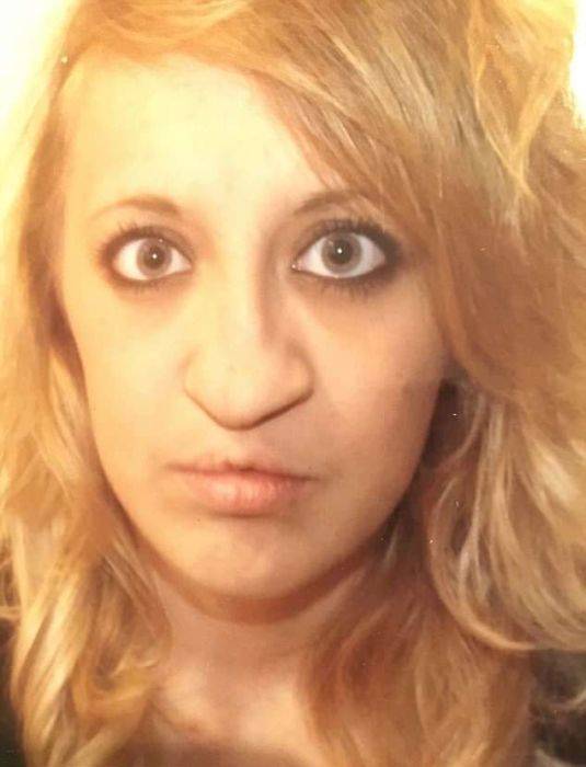 Girl With A Wolf Mouth 10 Operations Later…