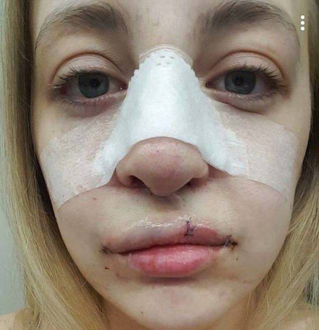 Girl With A Wolf Mouth 10 Operations Later…