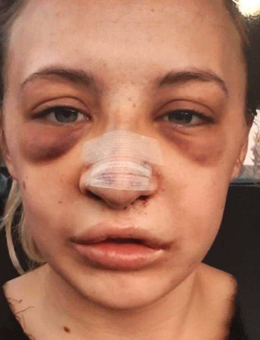 Girl With A Wolf Mouth 10 Operations Later…