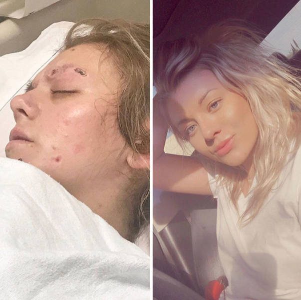 How Drug Addiction Looks Before And After