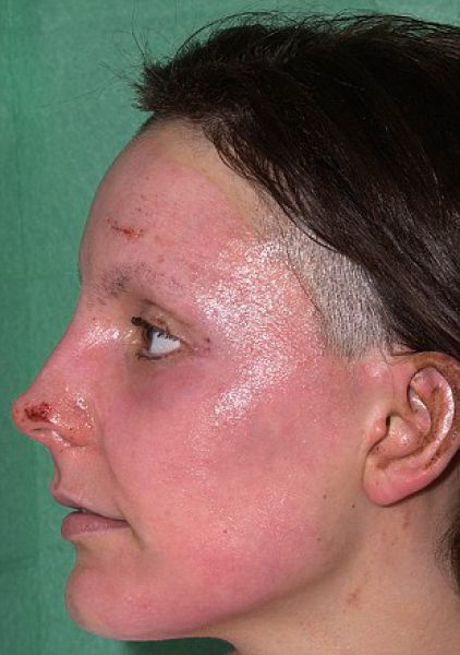 Incredible Healing after a Bomb Explosion (15 pics) Incredible Healing after a Bomb Explosion (15 pics)