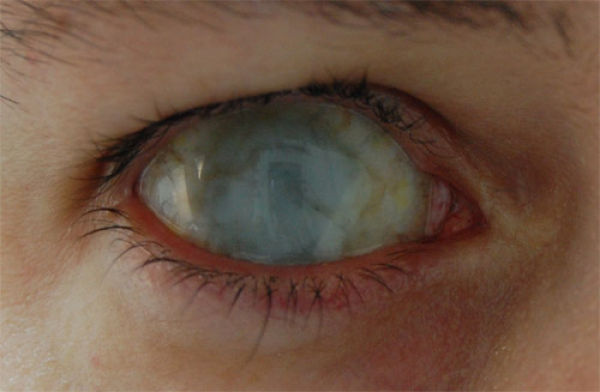 Eerie Eyeball Covers