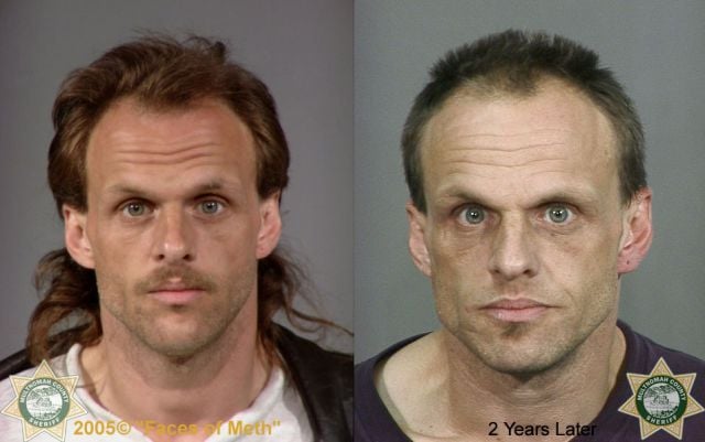 Meth Addicts: Before and After