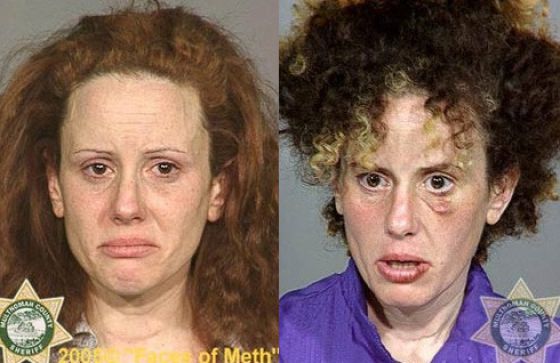 Meth Addicts: Before and After