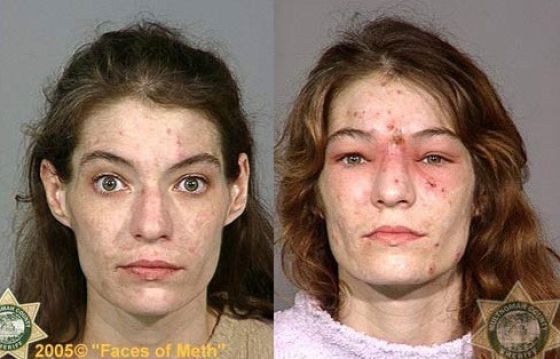 Meth Addicts: Before and After