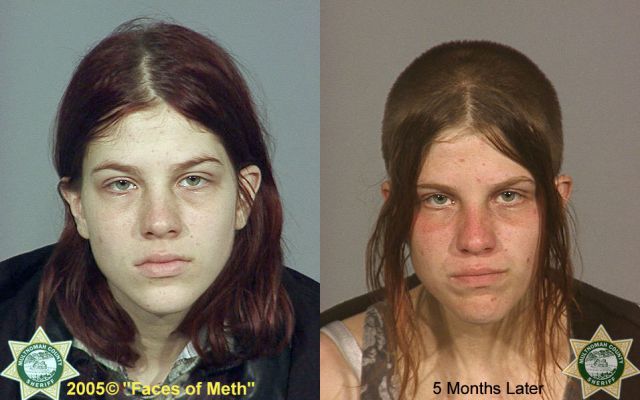 Meth Addicts: Before and After