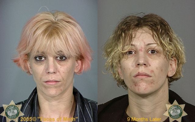Meth Addicts: Before and After