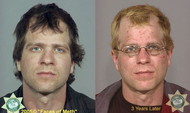 Meth Addicts: Before and After
