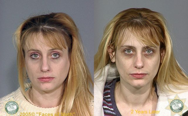 Meth Addicts: Before and After