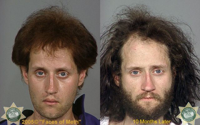 Meth Addicts: Before and After
