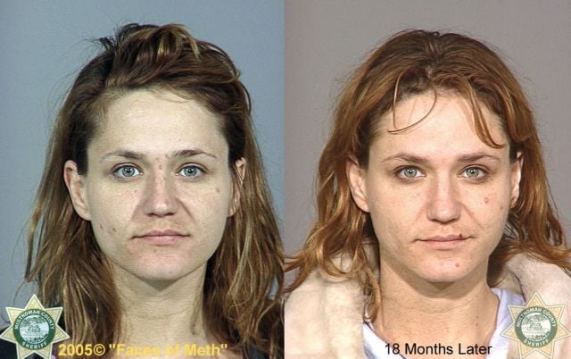 Meth Addicts: Before and After