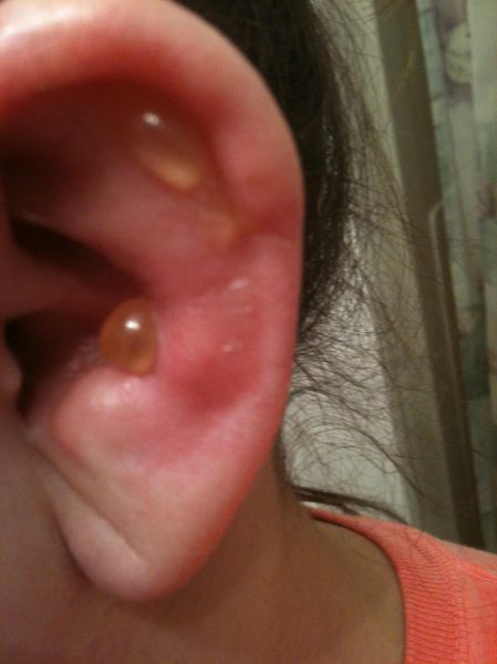 What a Brown Recluse Spider Bite Looks Like