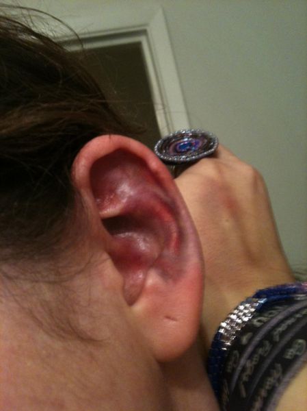 What a Brown Recluse Spider Bite Looks Like