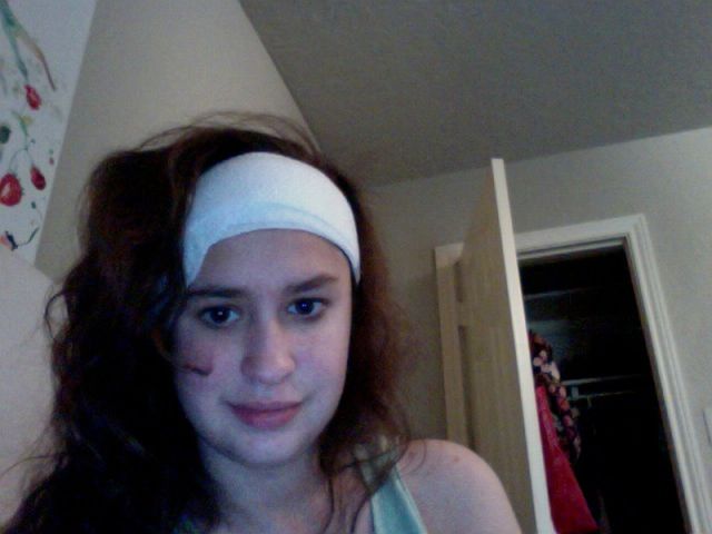 What a Brown Recluse Spider Bite Looks Like