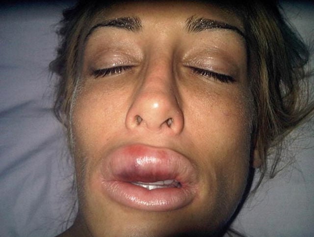 The Victim of Silicone