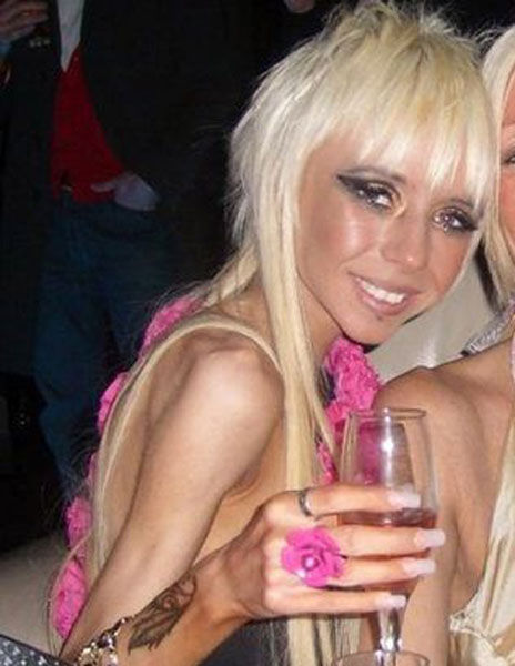 Girl Recovers From Anorexia After Being Nearly Hit by Car