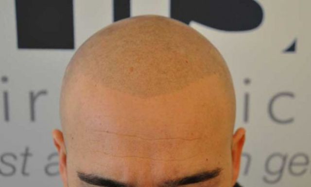 The ‘No Hair’ Solution!