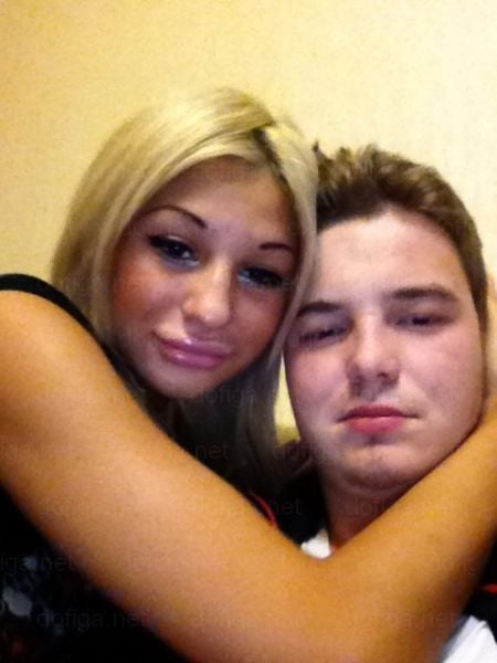 Before and After: Girl Gets a Dramatic Lip Enhancement