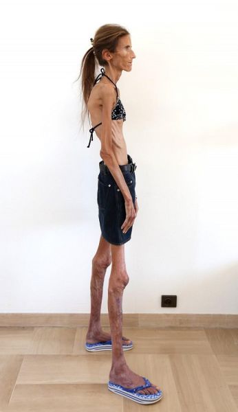 Her Dream Body Is Killing Her