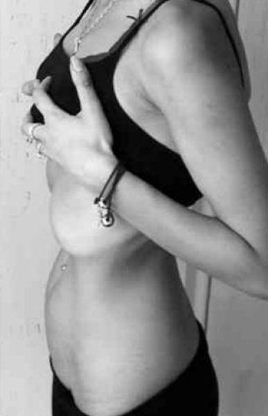 The Anorexic Pregnant Girl