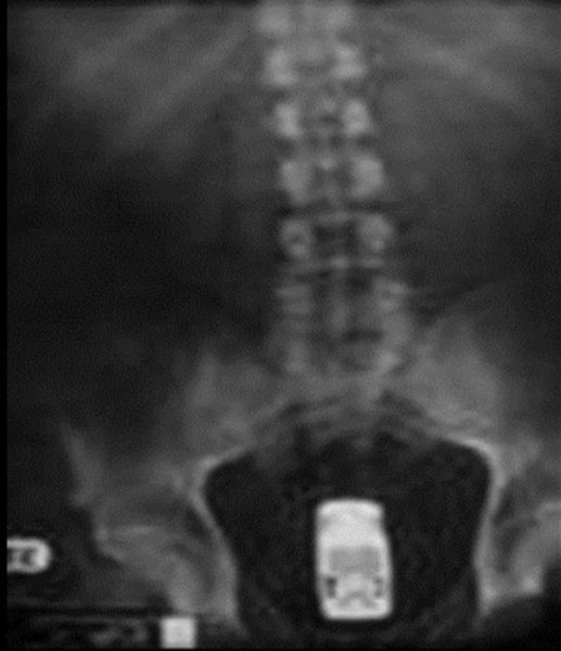 X-Rays That Prove That Horny Guys Are Idiots