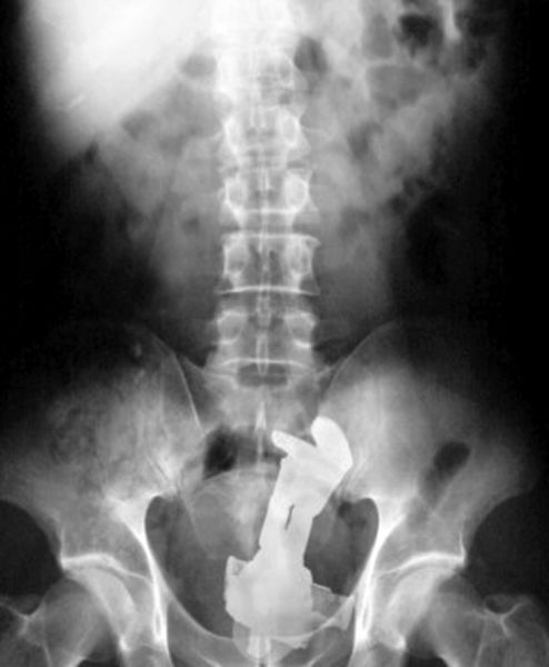 X-Rays That Prove That Horny Guys Are Idiots