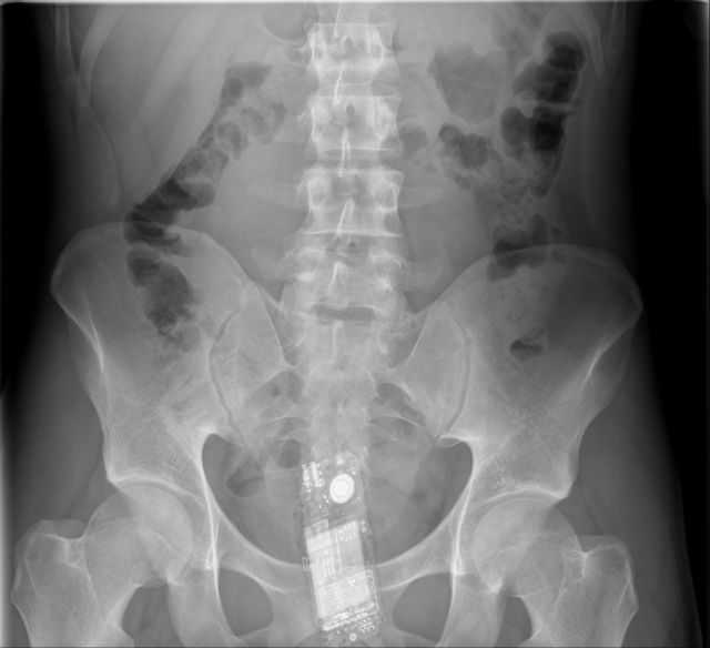 X-Rays That Prove That Horny Guys Are Idiots