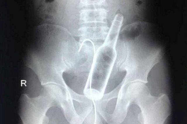 X-Rays That Prove That Horny Guys Are Idiots