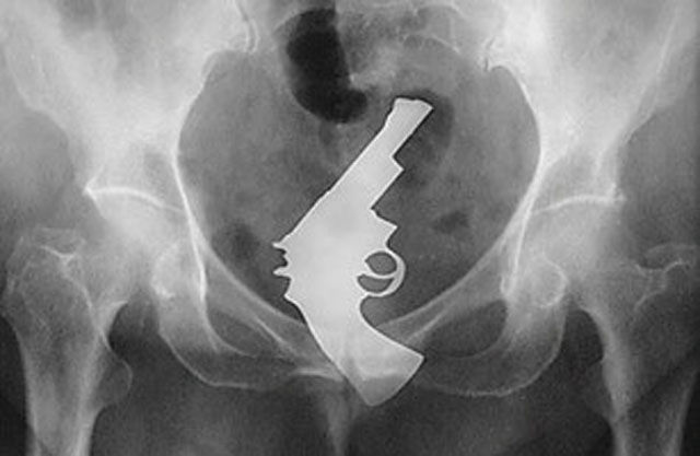 X-Rays That Prove That Horny Guys Are Idiots