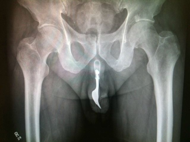 X-Rays That Prove That Horny Guys Are Idiots