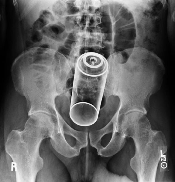 X-Rays That Prove That Horny Guys Are Idiots