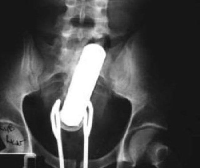 X-Rays That Prove That Horny Guys Are Idiots