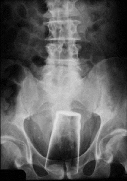 X-Rays That Prove That Horny Guys Are Idiots
