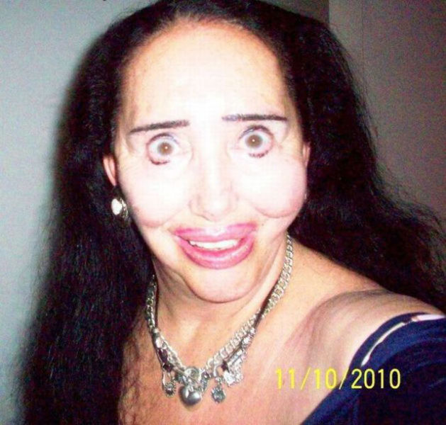 Plastic Surgery Fails That Are Just Wrong