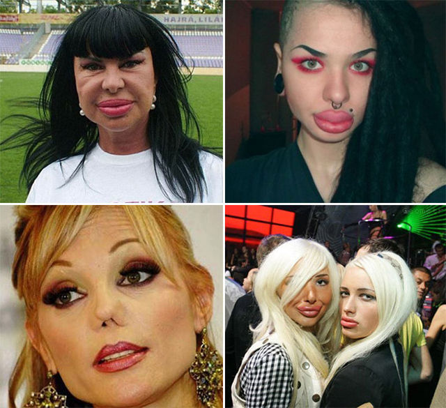 Plastic Surgery Fails That Are Just Wrong
